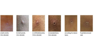 Stages of monkeypox lesions