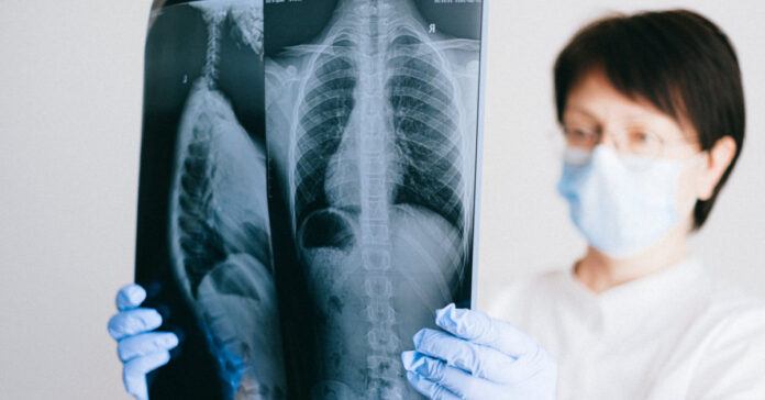 A chest X-ray can be used to diagnose pneumonia.