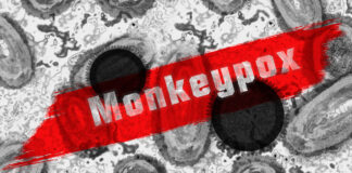 Monkeypox has spread beyond Africa. When will it reach the U.S.?