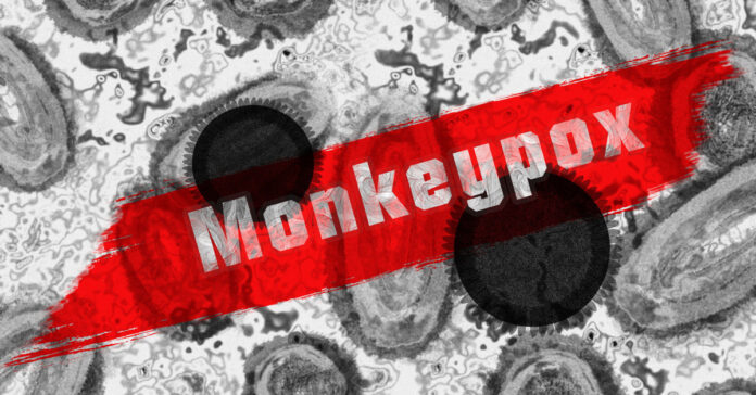 Monkeypox has spread beyond Africa. When will it reach the U.S.?