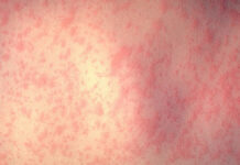 This rash appears a few days after becoming infect with measles. Photo courtesy of the CDC.