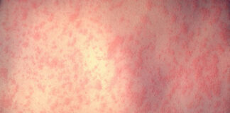 This rash appears a few days after becoming infect with measles. Photo courtesy of the CDC.