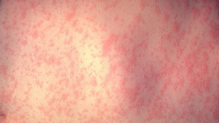 This rash appears a few days after becoming infect with measles. Photo courtesy of the CDC.